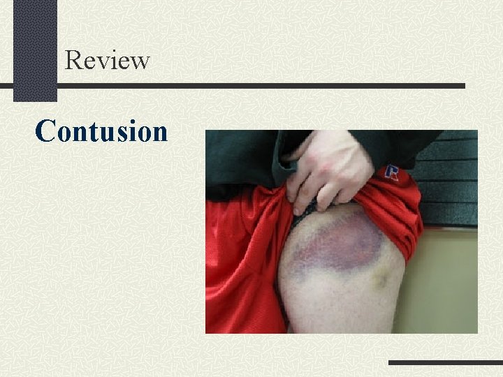 Review Contusion 