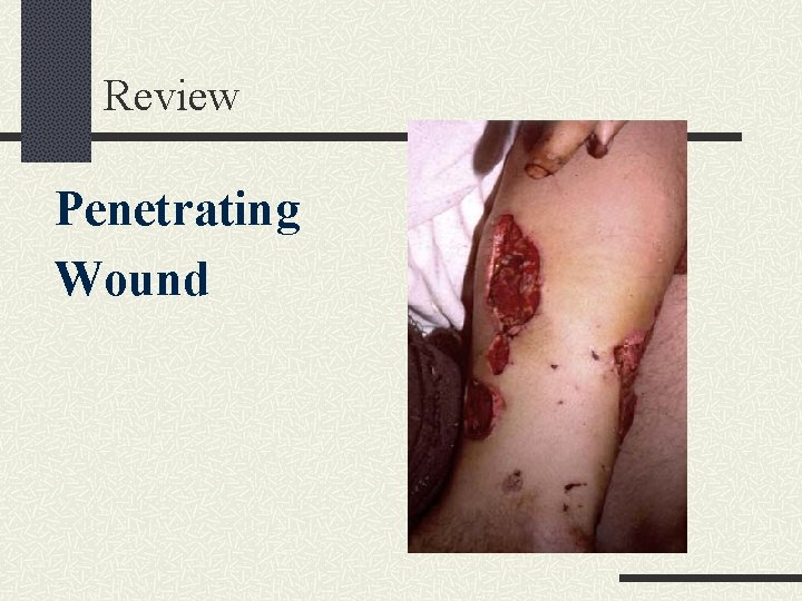 Review Penetrating Wound 