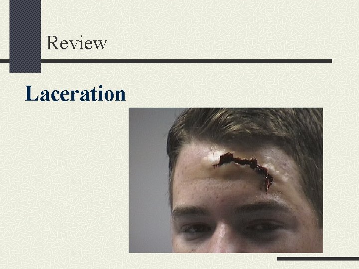 Review Laceration 