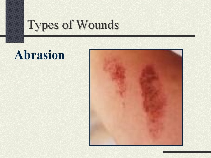 Types of Wounds Abrasion 