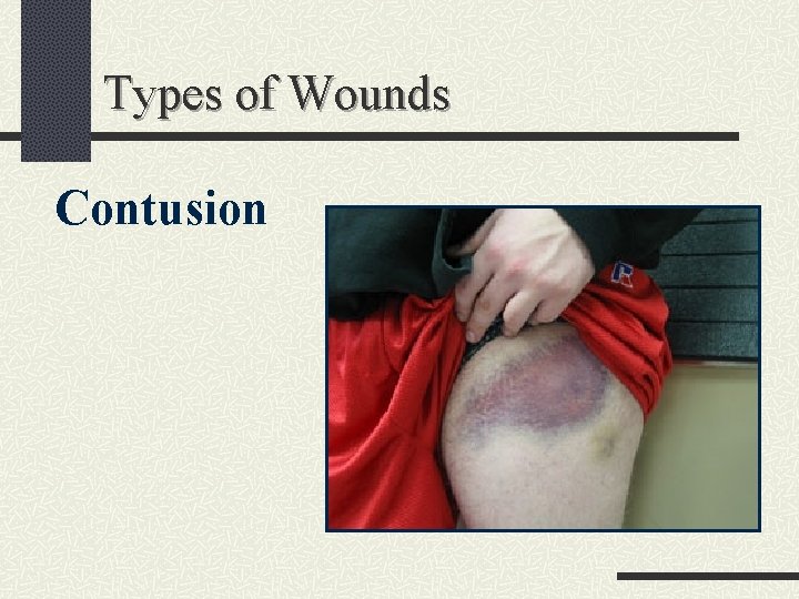 Types of Wounds Contusion 