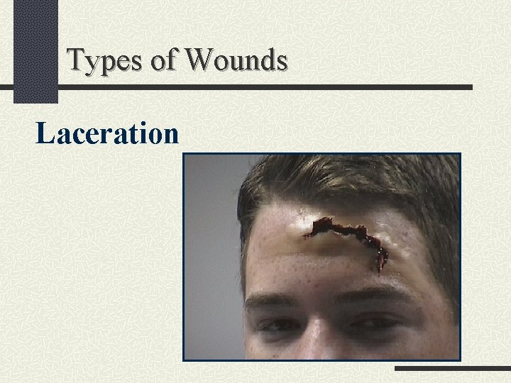 Types of Wounds Laceration 