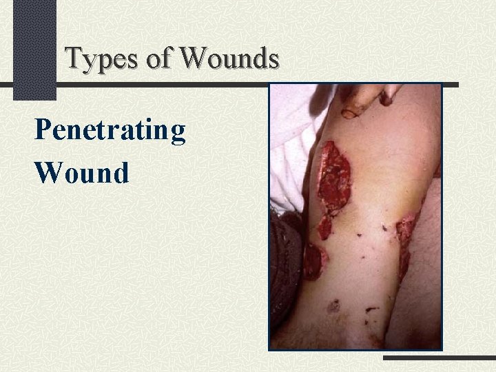 Types of Wounds Penetrating Wound 