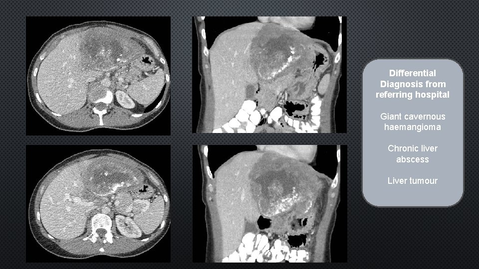 Differential Diagnosis from referring hospital Giant cavernous haemangioma Chronic liver abscess Liver tumour 