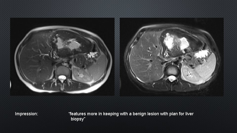 Impression: “features more in keeping with a benign lesion with plan for liver biopsy”