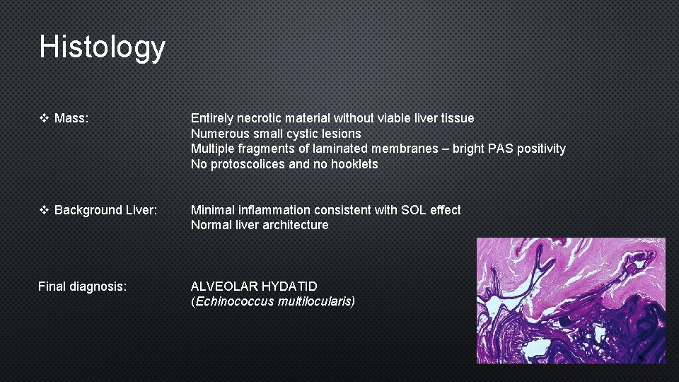 Histology v Mass: Entirely necrotic material without viable liver tissue Numerous small cystic lesions