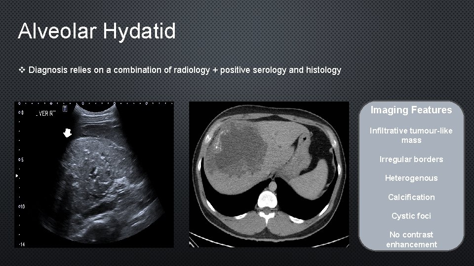 Alveolar Hydatid v Diagnosis relies on a combination of radiology + positive serology and