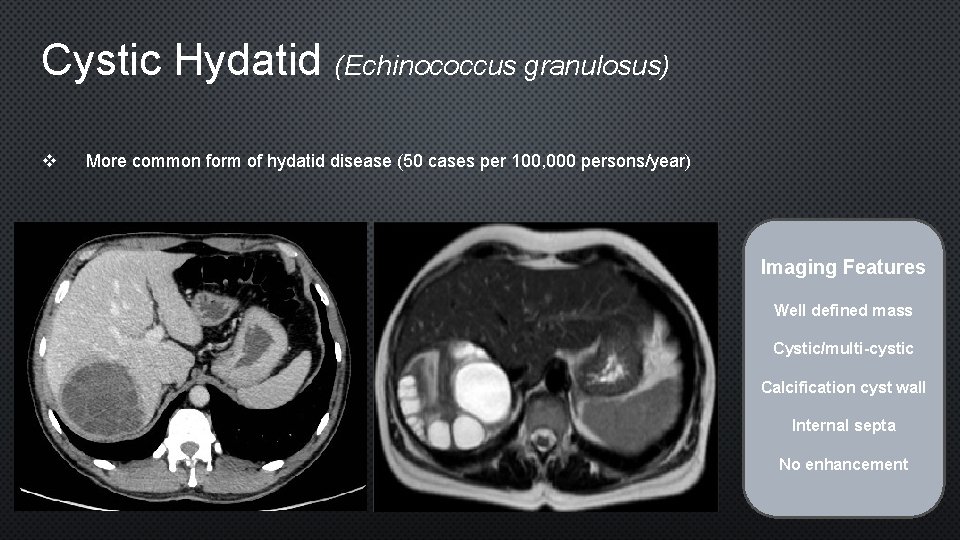 Cystic Hydatid (Echinococcus granulosus) v More common form of hydatid disease (50 cases per