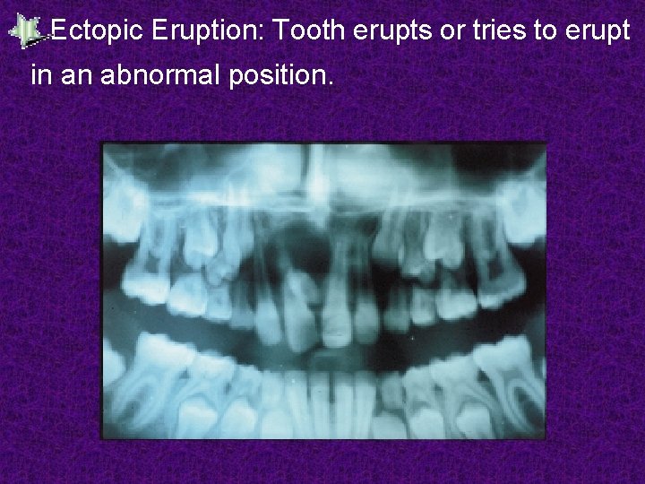 Ectopic Eruption: Tooth erupts or tries to erupt in an abnormal position. 