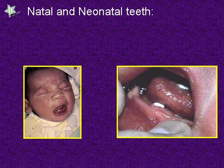 Natal and Neonatal teeth: 