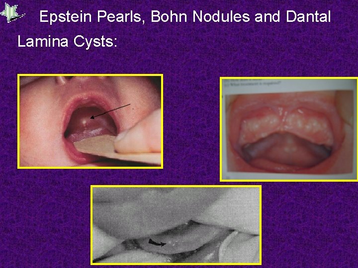 Epstein Pearls, Bohn Nodules and Dantal Lamina Cysts: 