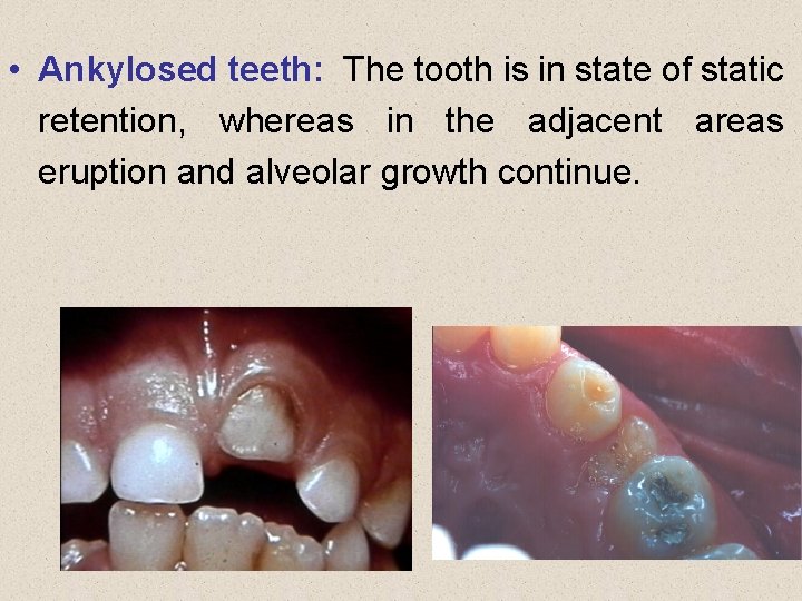  • Ankylosed teeth: The tooth is in state of static retention, whereas in