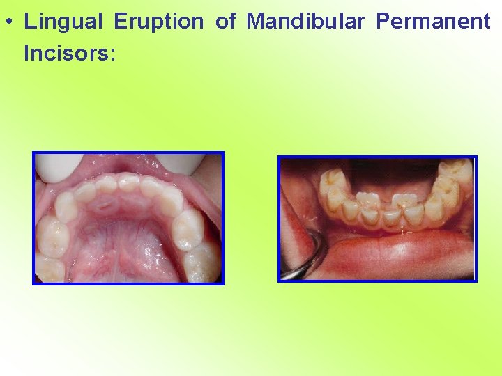  • Lingual Eruption of Mandibular Permanent Incisors: 