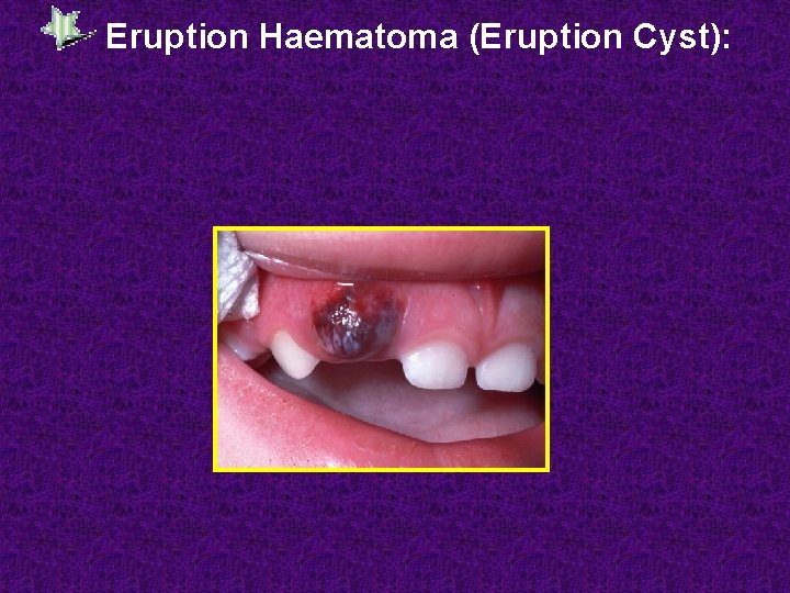 Eruption Haematoma (Eruption Cyst): 