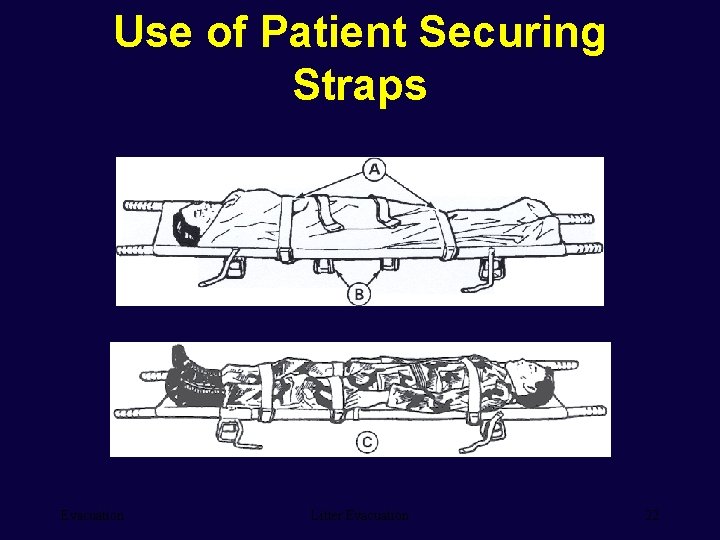 Use of Patient Securing Straps Evacuation Litter Evacuation 22 