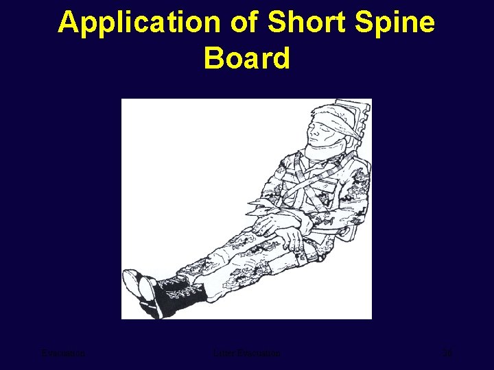 Application of Short Spine Board Evacuation Litter Evacuation 26 