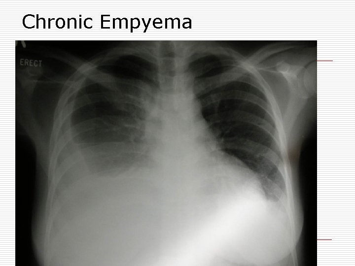 Chronic Empyema 