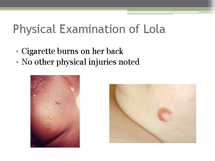 Physical Examination of Lola • Cigarette burns on her back • No other physical