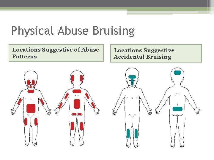 Physical Abuse Bruising Locations Suggestive of Abuse Patterns Locations Suggestive Accidental Bruising 