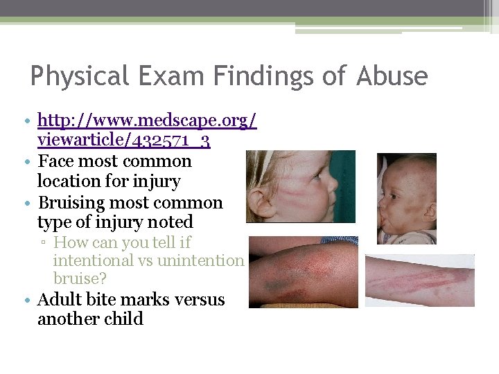 Physical Exam Findings of Abuse • http: //www. medscape. org/ viewarticle/432571_3 • Face most