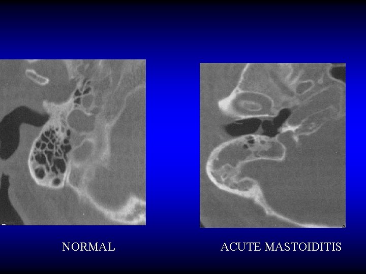 NORMAL ACUTE MASTOIDITIS 