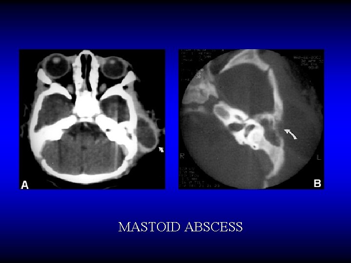 MASTOID ABSCESS 