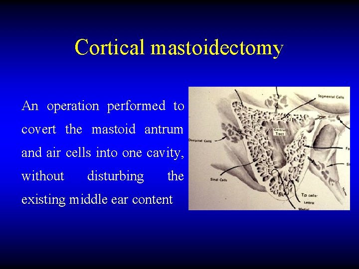 Cortical mastoidectomy An operation performed to covert the mastoid antrum and air cells into