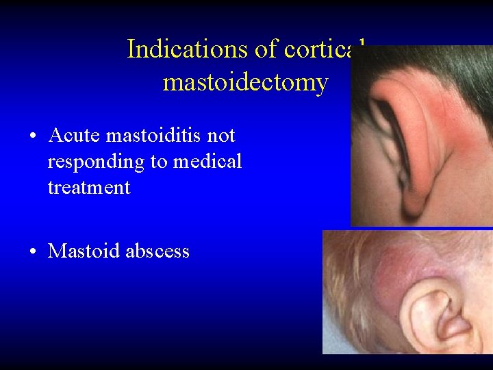 Indications of cortical mastoidectomy • Acute mastoiditis not responding to medical treatment • Mastoid