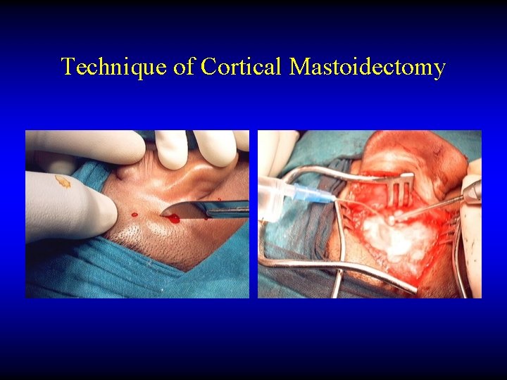 Technique of Cortical Mastoidectomy 