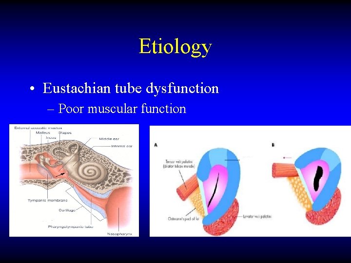 Etiology • Eustachian tube dysfunction – Poor muscular function 