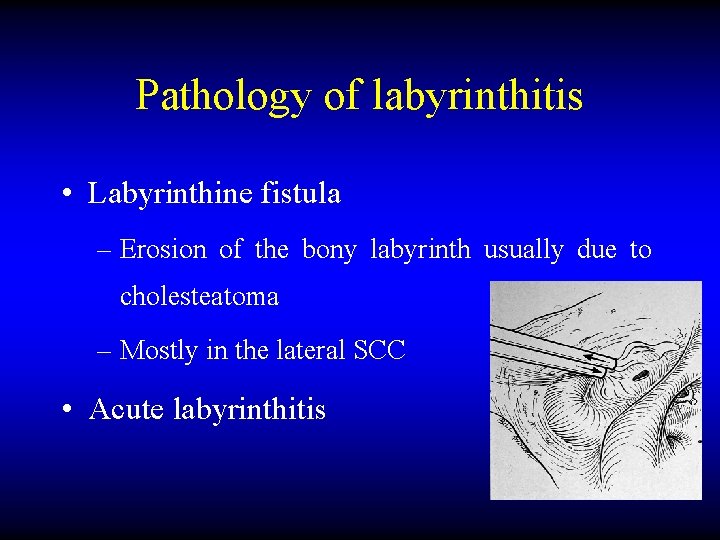 Pathology of labyrinthitis • Labyrinthine fistula – Erosion of the bony labyrinth usually due