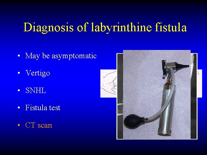 Diagnosis of labyrinthine fistula • May be asymptomatic • Vertigo • SNHL • Fistula