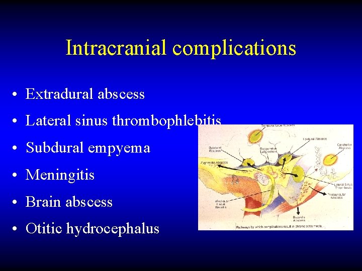 Intracranial complications • Extradural abscess • Lateral sinus thrombophlebitis • Subdural empyema • Meningitis