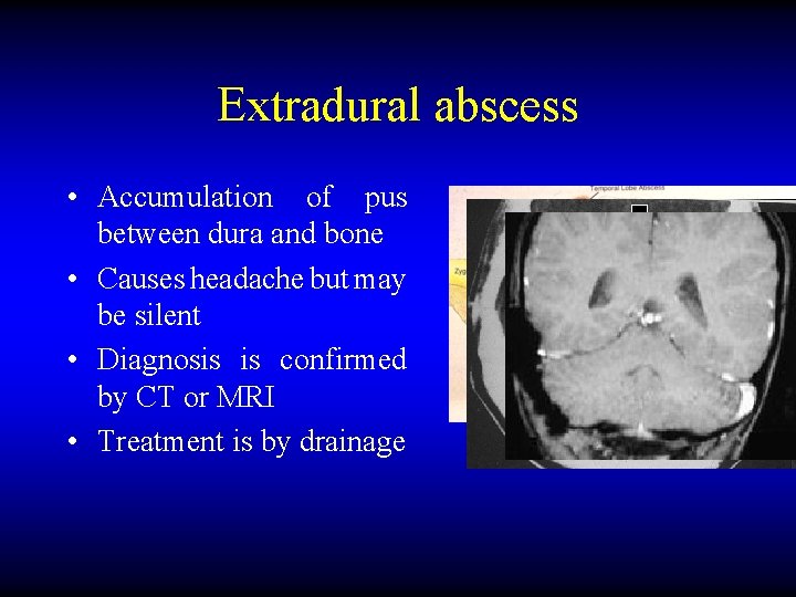 Extradural abscess • Accumulation of pus between dura and bone • Causes headache but