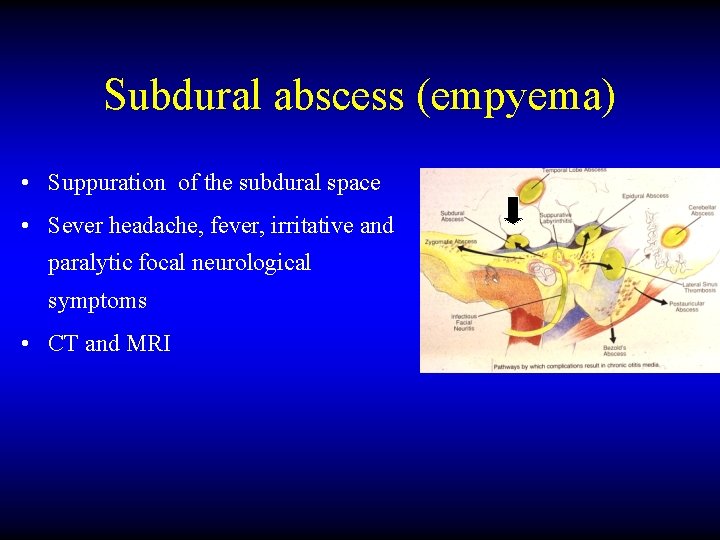 Subdural abscess (empyema) • Suppuration of the subdural space • Sever headache, fever, irritative