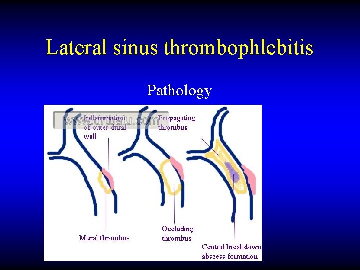 Lateral sinus thrombophlebitis Pathology 