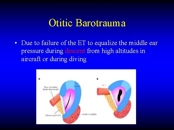 Otitic Barotrauma • Due to failure of the ET to equalize the middle ear