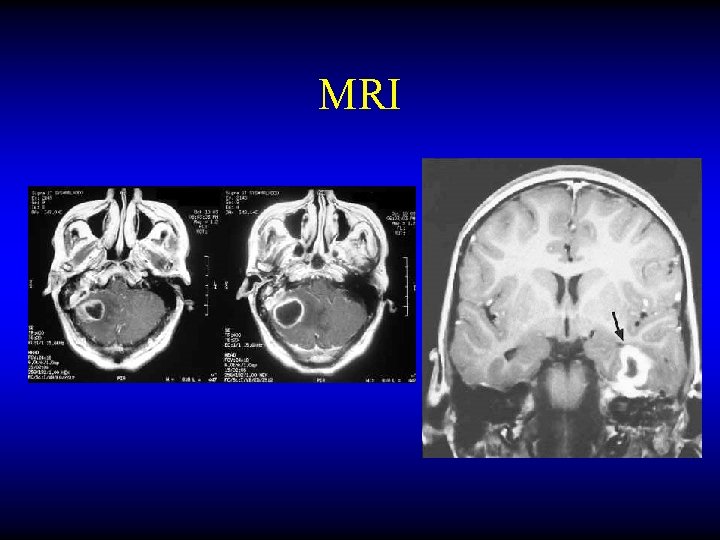 MRI 