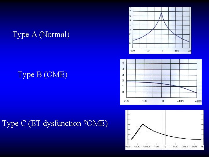 Type A (Normal) Type B (OME) Type C (ET dysfunction ? OME) 