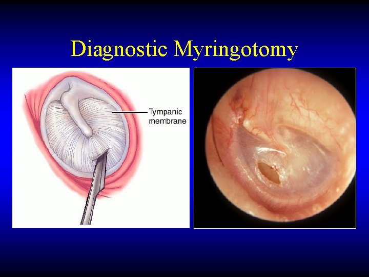 Diagnostic Myringotomy 
