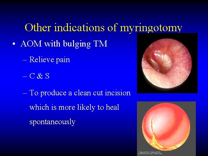 Other indications of myringotomy • AOM with bulging TM – Relieve pain –C&S –