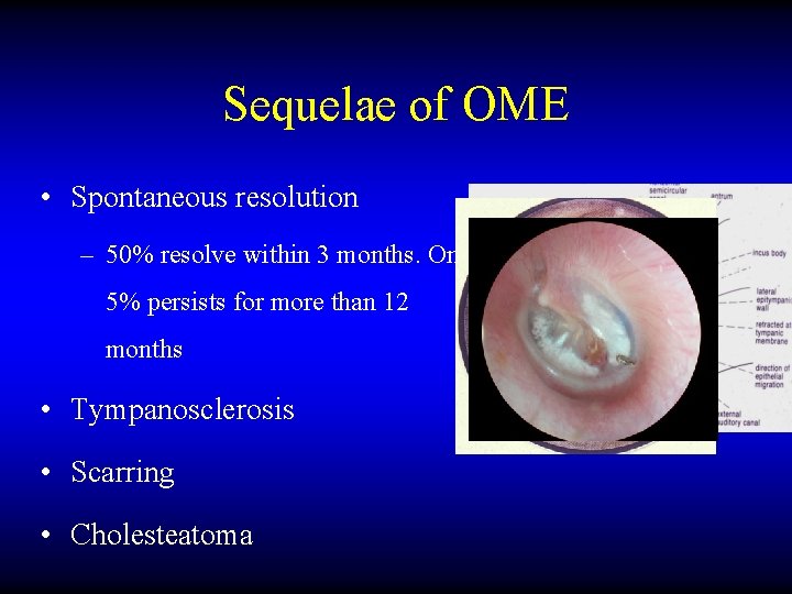 Sequelae of OME • Spontaneous resolution – 50% resolve within 3 months. Only 5%