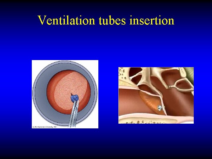 Ventilation tubes insertion 