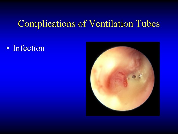Complications of Ventilation Tubes • Infection 