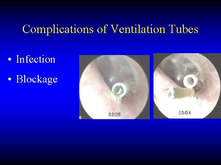Complications of Ventilation Tubes • Infection • Blockage 