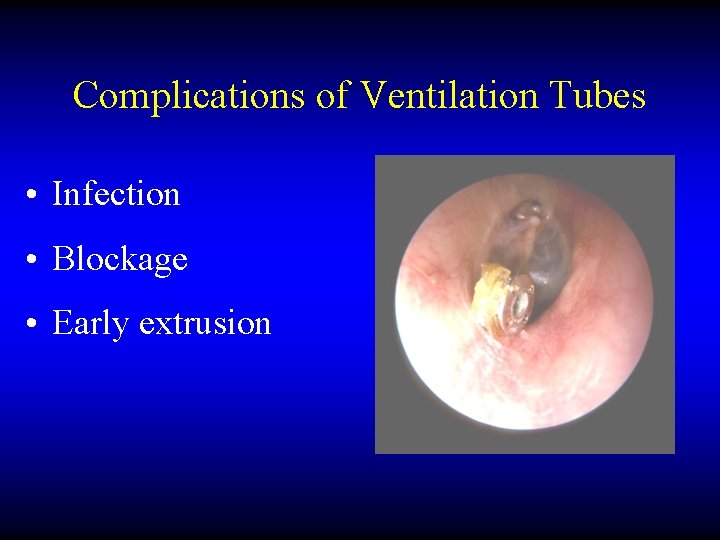 Complications of Ventilation Tubes • Infection • Blockage • Early extrusion 