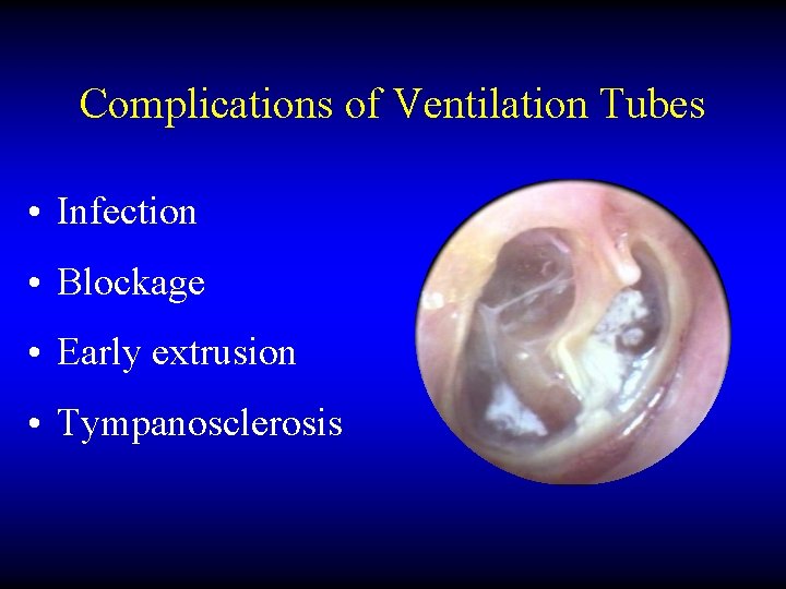 Complications of Ventilation Tubes • Infection • Blockage • Early extrusion • Tympanosclerosis 