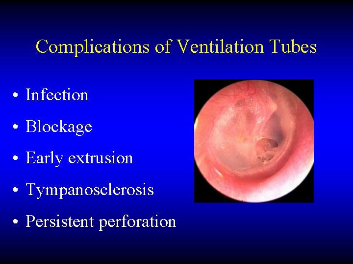 Complications of Ventilation Tubes • Infection • Blockage • Early extrusion • Tympanosclerosis •