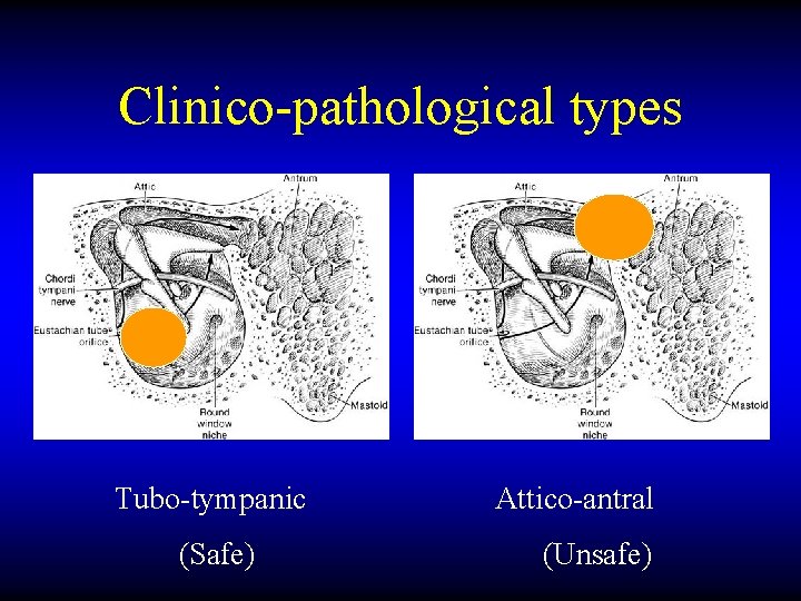 Clinico-pathological types Tubo-tympanic (Safe) Attico-antral (Unsafe) 