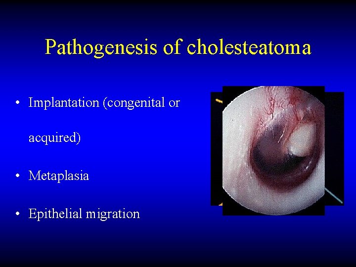 Pathogenesis of cholesteatoma • Implantation (congenital or acquired) • Metaplasia • Epithelial migration 